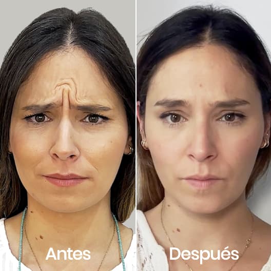antes y despues Arrugas entrecejo y patas de gallo