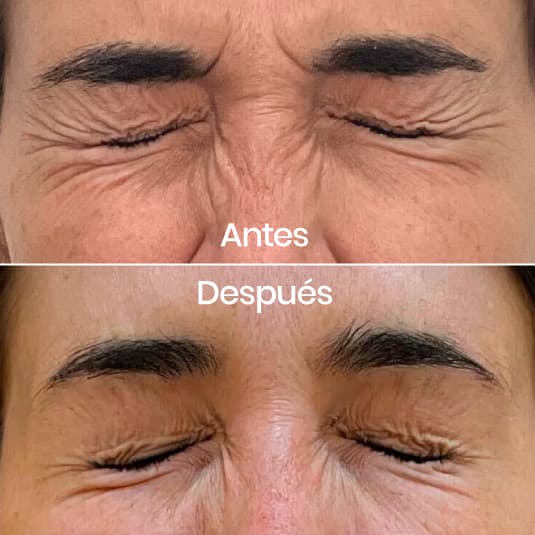 antes y despues Arrugas entrecejo y patas de gallo
