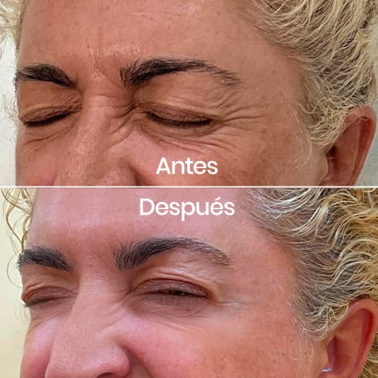antes y despues Arrugas entrecejo y patas de gallo