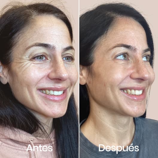 antes y despues Arrugas de expresión
