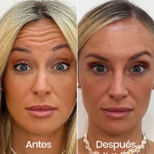 antes y despues Arrugas expresión: Frente, entrecejo y patas de gallo