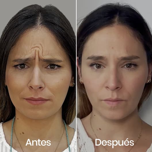 antes y despues Arrugas expresión: Frente, entrecejo y patas de gallo
