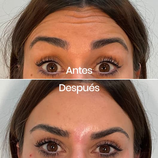 antes y despues Arrugas expresión: Frente, entrecejo y patas de gallo