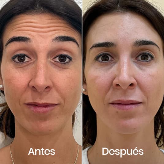 Tratamiento para arrugas de expresión en Holaglow