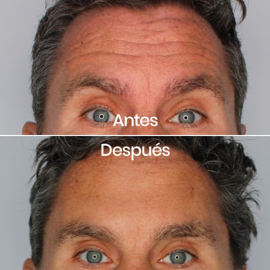 antes y despues Arrugas expresión: Frente, entrecejo y patas de gallo