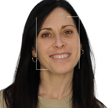 Antes y después del tratamiento: Armonización facial